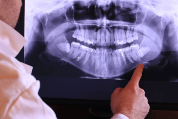 Best Emergency Wisdom Teeth Removal in Montrose, MN