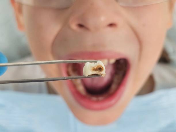 Best Emergency Treatment for Dental Infections or Abscesses in Montrose, MN